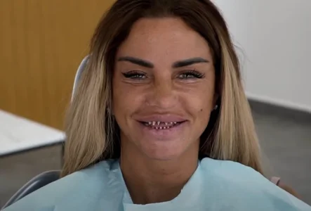 Katie-Price-teeth-without-crowns-1024x695.webp