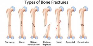 BoneFractures.jpg