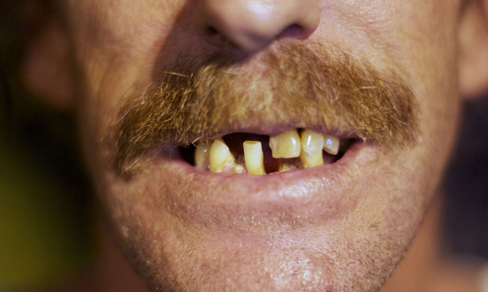 bad-teeth.jpg